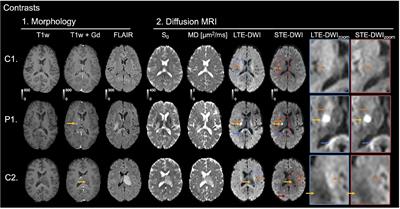 Separating Glioma Hyperintensities From White Matter by Diffusion-Weighted Imaging With Spherical Tensor Encoding